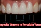 Complete Guide to Composite Veneers vs Porcelain Veneers