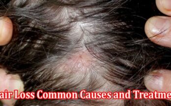 About General Information Hair Loss Common Causes and Treatment